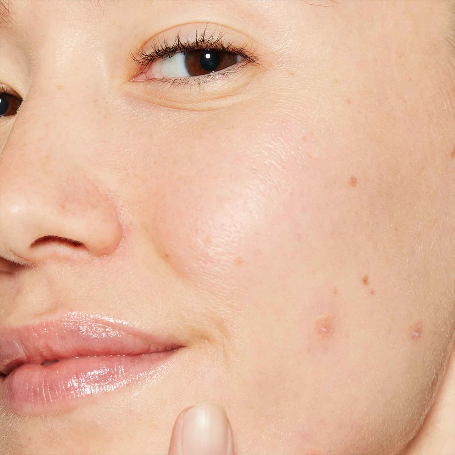 Deep Acne Liquid Patch